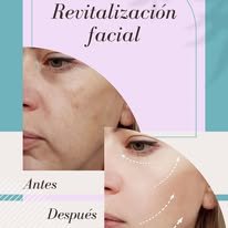 Resultados clínicos antes y después de tratamiento de revitalización facial
